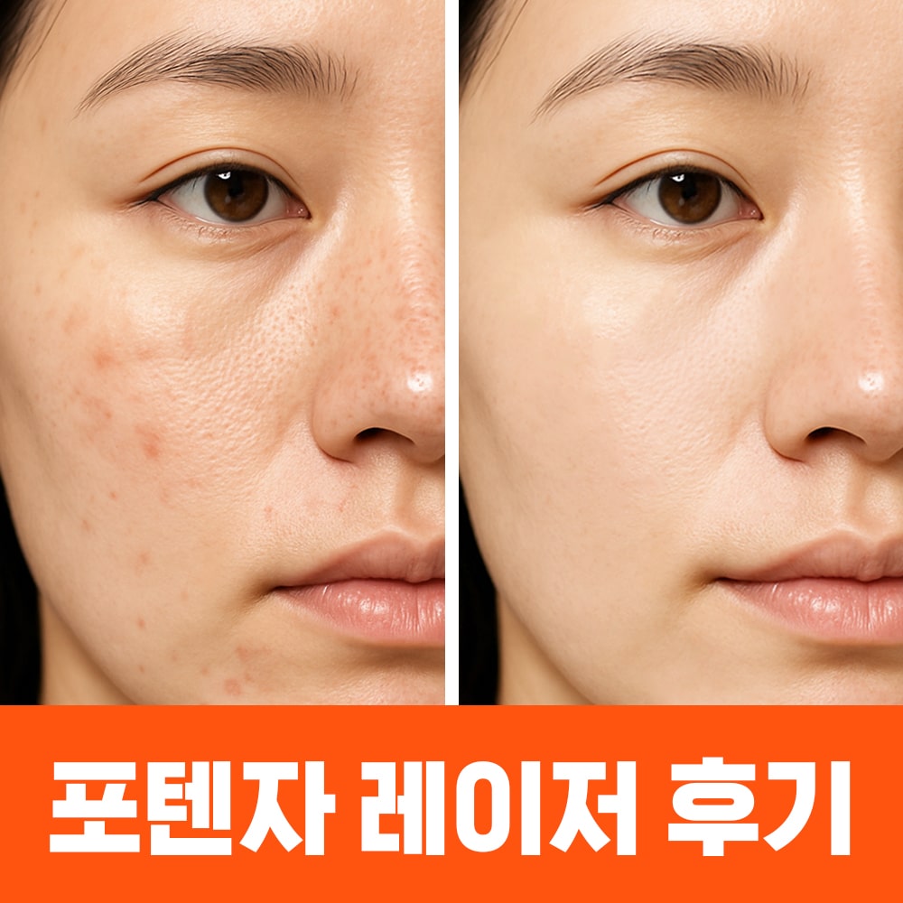 포텐자 레이저 전후 후기