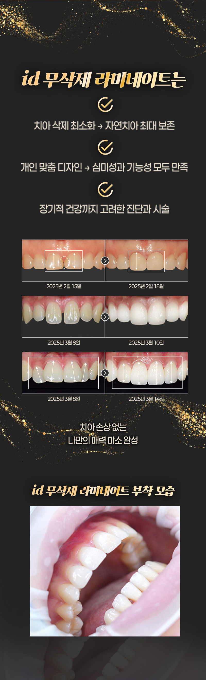 누런니로 치아 색깔이 맘에 안들고  
토끼이, 벌어진 치아가 고민이라면
아이디 무삭제 라미네이트로 고민해결! 

오랜기간 쌓아온 노하우가 담긴
렌즈보다 얇은 라미네이트 
소중한 내 치아를 삭제할 필요 없고
튼튼한 내구성으로도 파절 걱정 제로!  

- 단 한 번의 내원으로 완성되는 라미네이트 
- 불필요한 손상 없이 자연스러운 치아 볼륨감을 형성하는 극강의 얇기 
- 쉽게 파절되지 않는 내구성 
- 치아의 색조와 질감의 재현으로 내추럴한 아름다움
- 속치아가 비치치 않는 깔끔함
- 치료 경험이 풍부한 전담의와 기공 노하우가 풍부한 기공사들의 정교한 공조
- 치아 스캐닝, 디자인, 밀링 등 전과정 디지털 시스템과 수석 기공사 노하우의 정밀함 