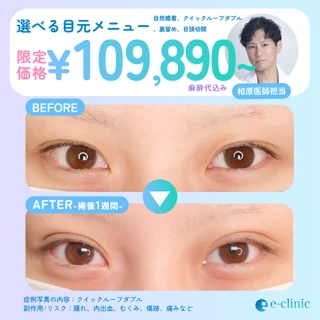 【麻酔代込み】選べる目元メニュー【相原医師限定】