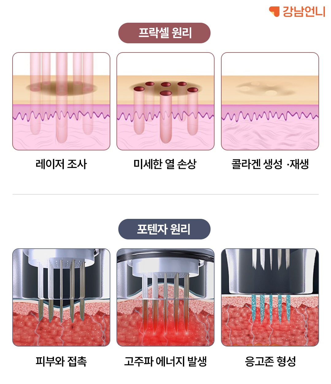 프락셀 포텐자 원리 차이