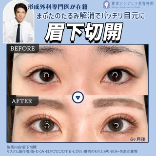 眉下切開|まぶたのたるみ解消でパッチリ目元に
