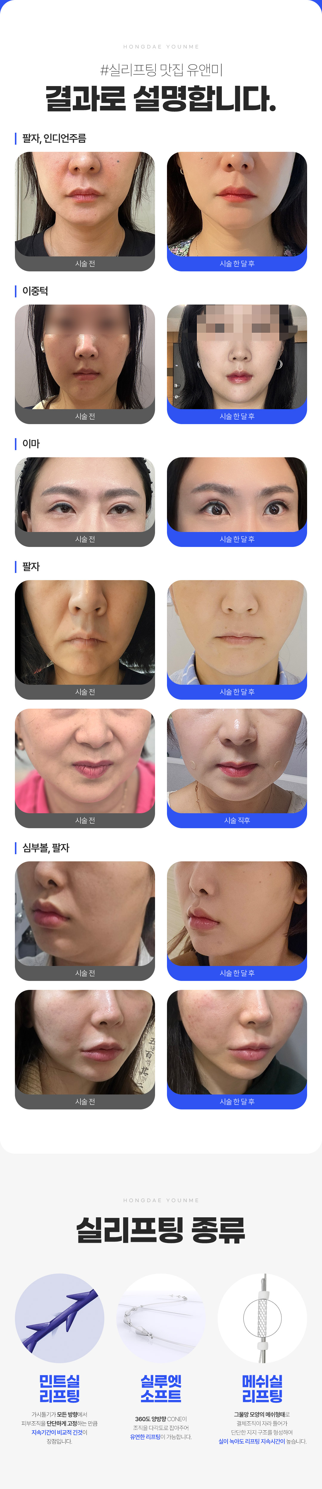 짧은 시술시간으로 확실한 리프팅 유앤미 실리프팅