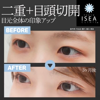 二重全切開 +目頭切開