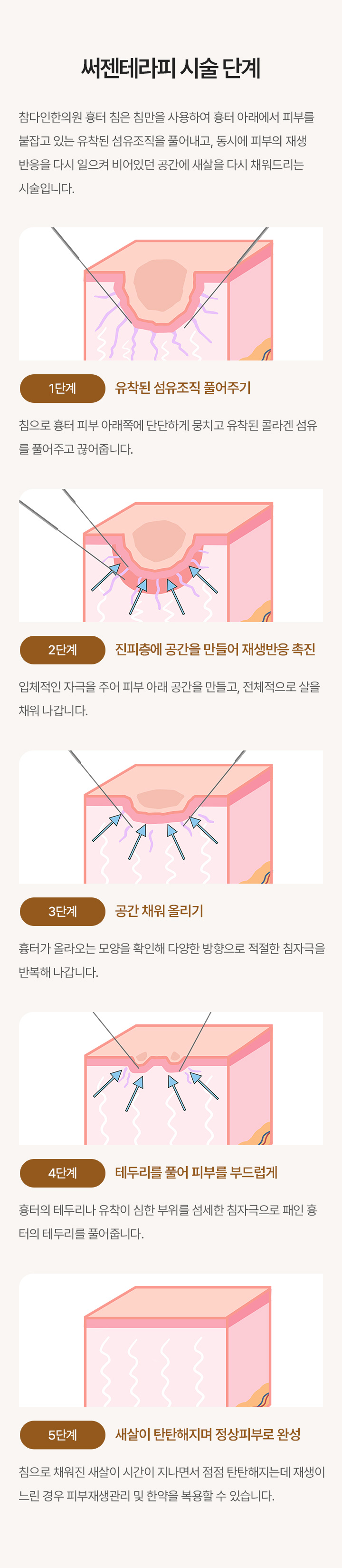 얼굴에 생긴 패인 흉터에 내 살을 재생시켜 채워 올리는 흉터침 시술. 첫방문 최대 2개까지 1회 체험해 볼 수 있는 기회. 한번의 시술로도 차이를 느낄 수 있습니다.