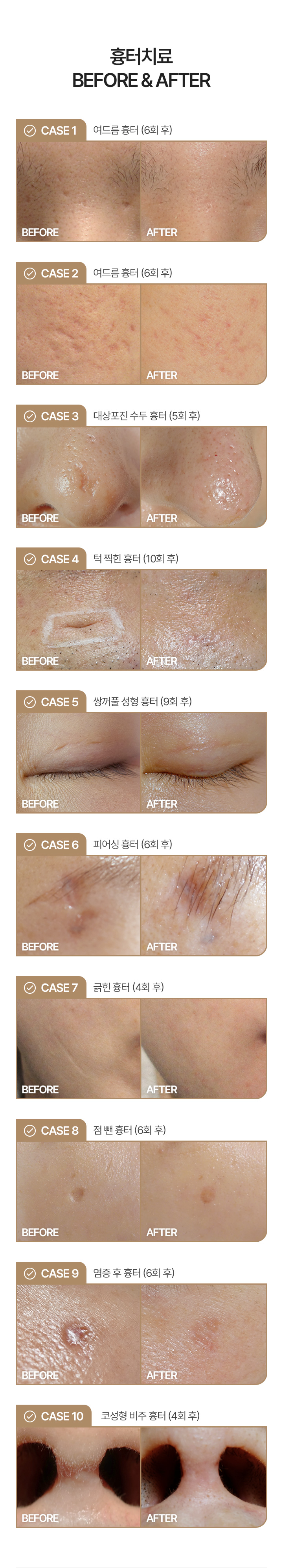 얼굴에 생긴 패인 흉터에 내 살을 재생시켜 채워 올리는 흉터침 시술. 첫방문 최대 2개까지 1회 체험해 볼 수 있는 기회. 한번의 시술로도 차이를 느낄 수 있습니다.