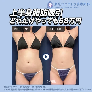 上半身脂肪吸引|どれだけやってもこの価格!|ペラペラになりたい方はこれ◎