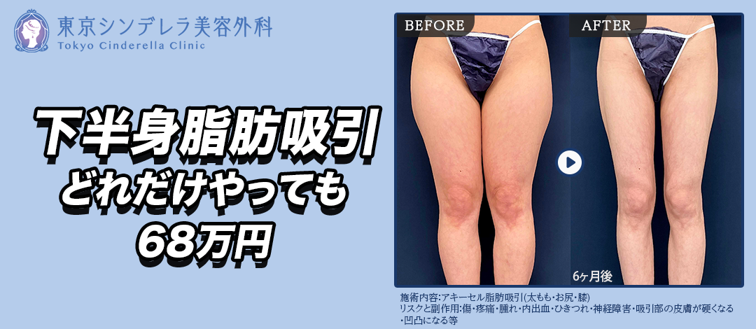 下半身フル脂肪吸引｜どれだけやってもこの価格！｜隙間のある理想の