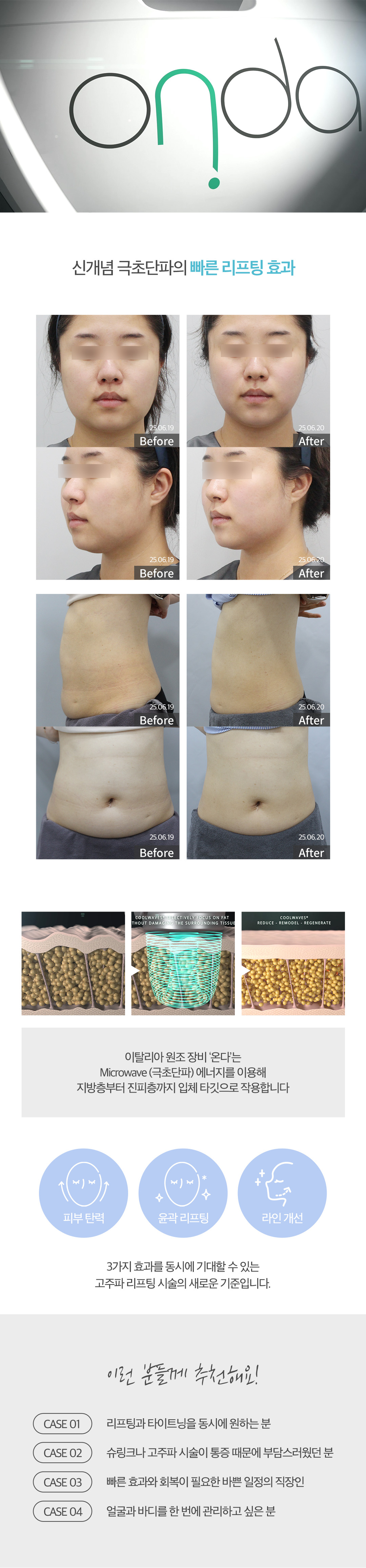 ONDA LIFTING 온다 리프팅
신개념 극초단파 리프팅 시스템

이탈리아 원조 장비 온다는
Microwave (극초단파) 에너지를 이용해
지방층부터 진피층까지 입체 타깃으로 작용합니다.

피부 탄력
윤곽 리프팅
라인 개선

3가지 효과를 동시에 기대할 수 있는
고주파 리프팅 시술의 새로운 기준입니다.

