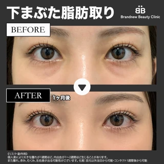 クマ治療｜下まぶた脂肪取り（脱脂） 麻酔代込