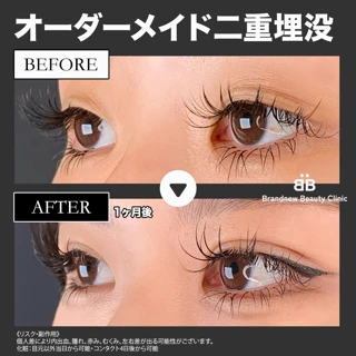 6点線留めや自然癒着法、裏留めもOK！｜オーダーメイド二重埋没法