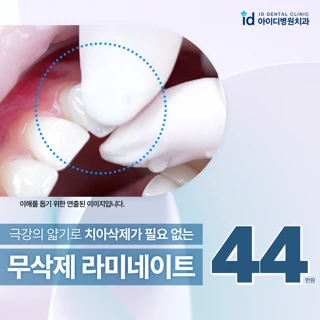 라미네이트 고민끝, 아이디 무삭제 라미네이트