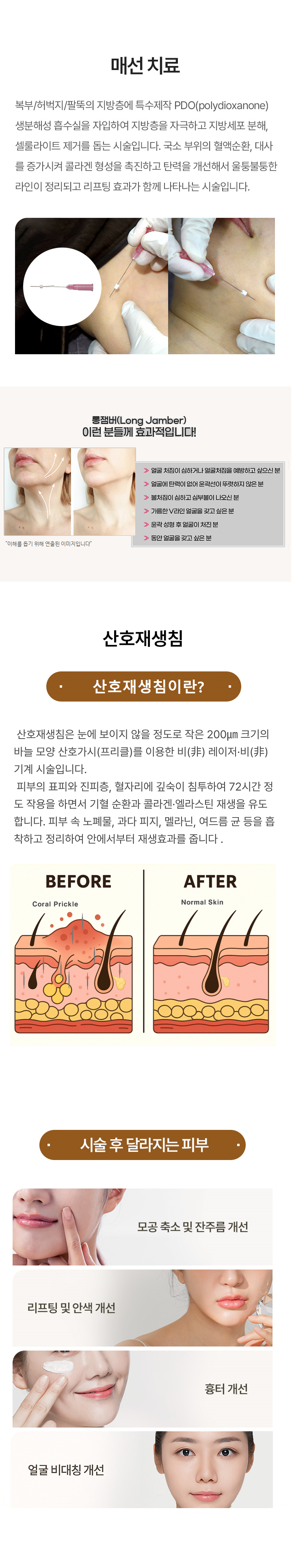 불필요한 손상없이 진피층 피부 재생을 통해 모공과 잔주름을 개선하고, 피부를 더욱 매끈하고 밝게 만들어 주는 시술입니다.
피부 타입에 따른 4회의 참다인 미백, 모공, 여드름, 붉은기, 리프팅 피부 솔루션을 특별한 체험가격으로 만나실 수 있습니다.
매선리프팅은 특수제작 PDO(polydioxanone) 생분해성 흡수실을 고민이 되는 피부 SMAS층에 매립하는 시술입니다.
삽입된 매선 안팎으로 자가콜라겐이 합성되어 자연스러운 볼륨감을 채워주고 콜라겐 층이 만들어져 주름 개선, 피부탄력증가 효과가 있는 시술입니다.
채움매선은 스프링 형태의 젬버실을 삽입하여 꺼진 부위의 볼륨을 더욱 채워주어 팔자주름, 볼패임, 얼굴처짐 등에 효과적입니다.
