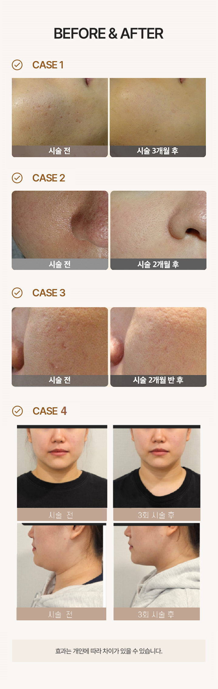 불필요한 손상없이 진피층 피부 재생을 통해 모공과 잔주름을 개선하고, 피부를 더욱 매끈하고 밝게 만들어 주는 시술입니다.
피부 타입에 따른 4회의 참다인 미백, 모공, 여드름, 붉은기, 리프팅 피부 솔루션을 특별한 체험가격으로 만나실 수 있습니다.
매선리프팅은 특수제작 PDO(polydioxanone) 생분해성 흡수실을 고민이 되는 피부 SMAS층에 매립하는 시술입니다.
삽입된 매선 안팎으로 자가콜라겐이 합성되어 자연스러운 볼륨감을 채워주고 콜라겐 층이 만들어져 주름 개선, 피부탄력증가 효과가 있는 시술입니다.
채움매선은 스프링 형태의 젬버실을 삽입하여 꺼진 부위의 볼륨을 더욱 채워주어 팔자주름, 볼패임, 얼굴처짐 등에 효과적입니다.