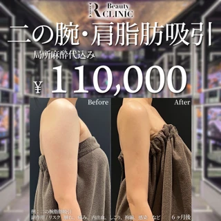 二の腕+肩 脂肪吸引|局所麻酔代/薬代込み|アフターケア充実◎気になる脂肪を根こそぎ吸引