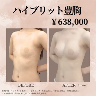 ハイブリッド豊胸（シリコン＋脂肪注入）｜ボリュームとナチュラルさを両立