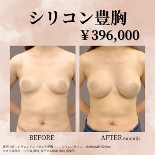 シリコン豊胸 Motiva  どのサイズも一定価格  形成外科出身の医師が担当