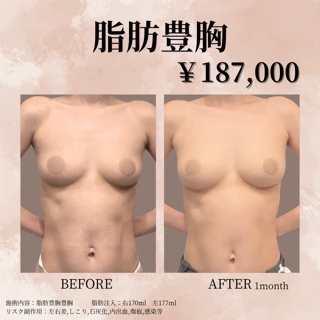 脂肪豊胸｜採取代込｜触り心地◎ナチュラルにバストアップ