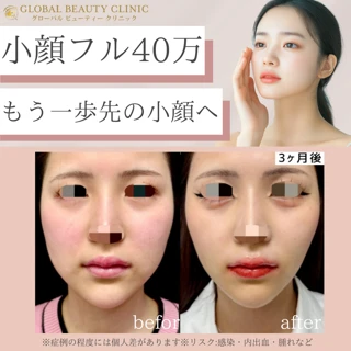 小顔フル整形40万円（脂肪吸引・糸リフト・あご形成・ボトックス・ヒアルロン酸）