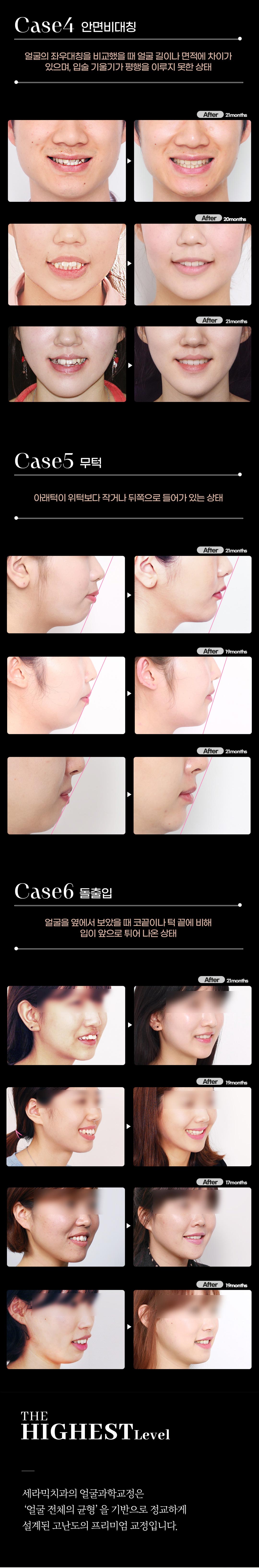 얼굴의 라인까지 아름다운 치아교정