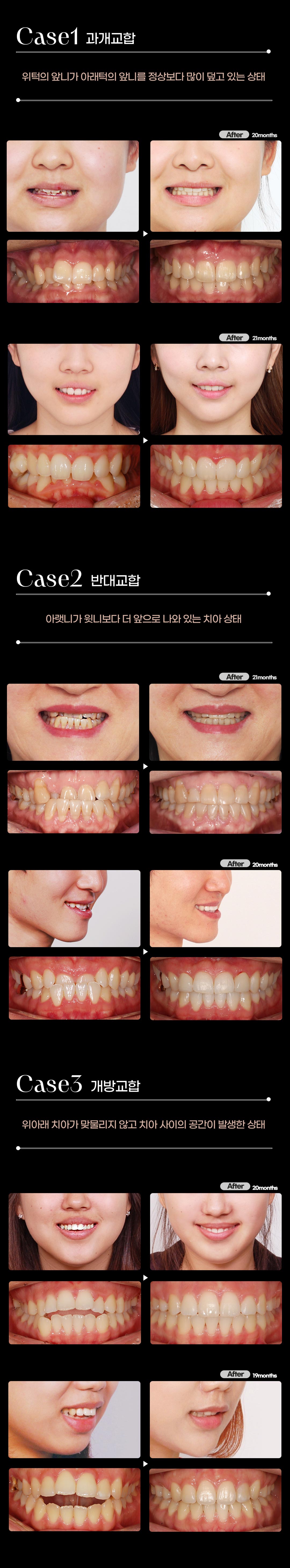 얼굴의 라인까지 아름다운 치아교정