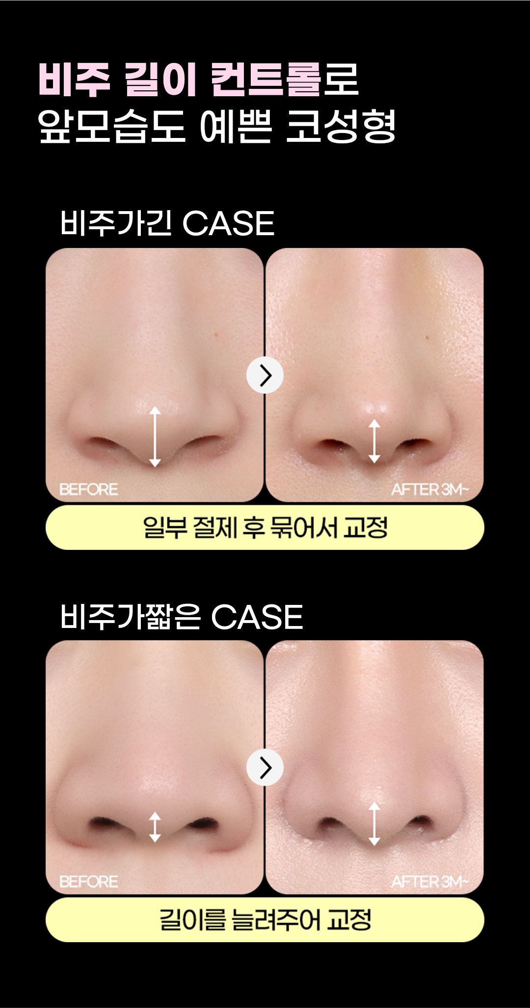 자연스럽고 화려한 코라인, 맞춤 디자인과 자가연골 사용으로 자연스럽고 화려한 예쁜 코라인을 완성