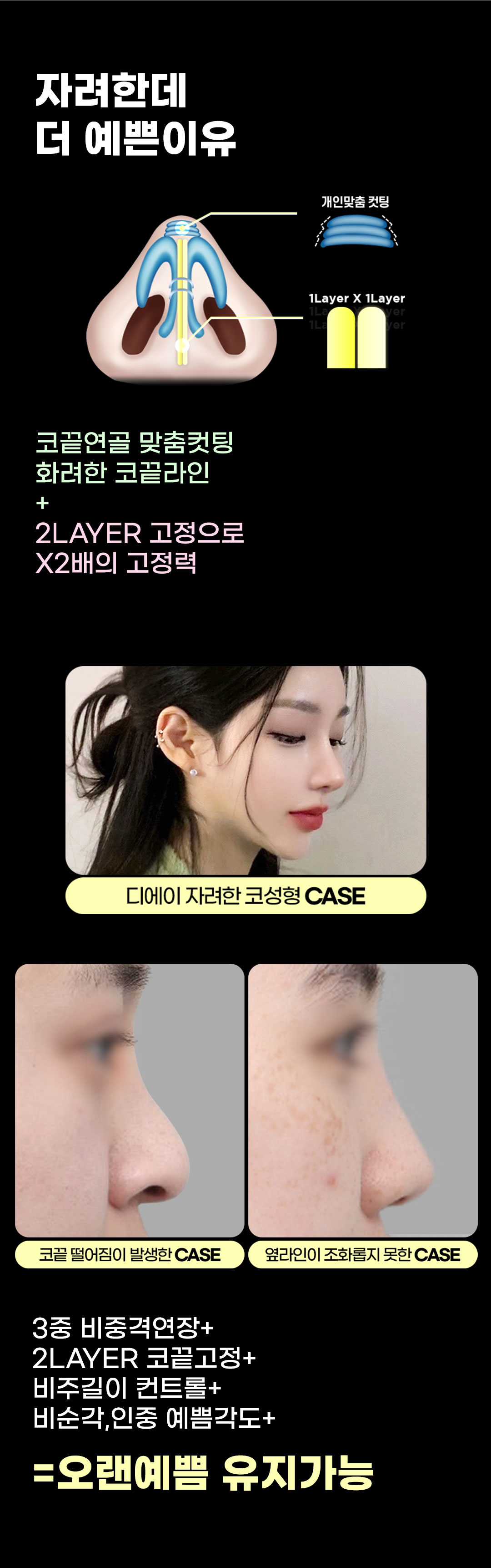 자연스럽고 화려한 코라인, 맞춤 디자인과 자가연골 사용으로 자연스럽고 화려한 예쁜 코라인을 완성