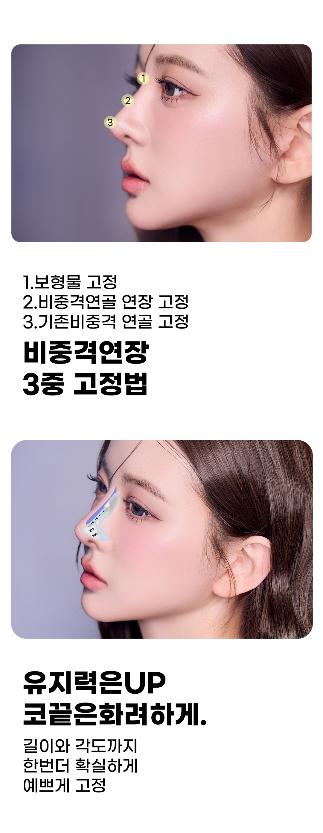 자연스럽고 화려한 코라인, 맞춤 디자인과 자가연골 사용으로 자연스럽고 화려한 예쁜 코라인을 완성