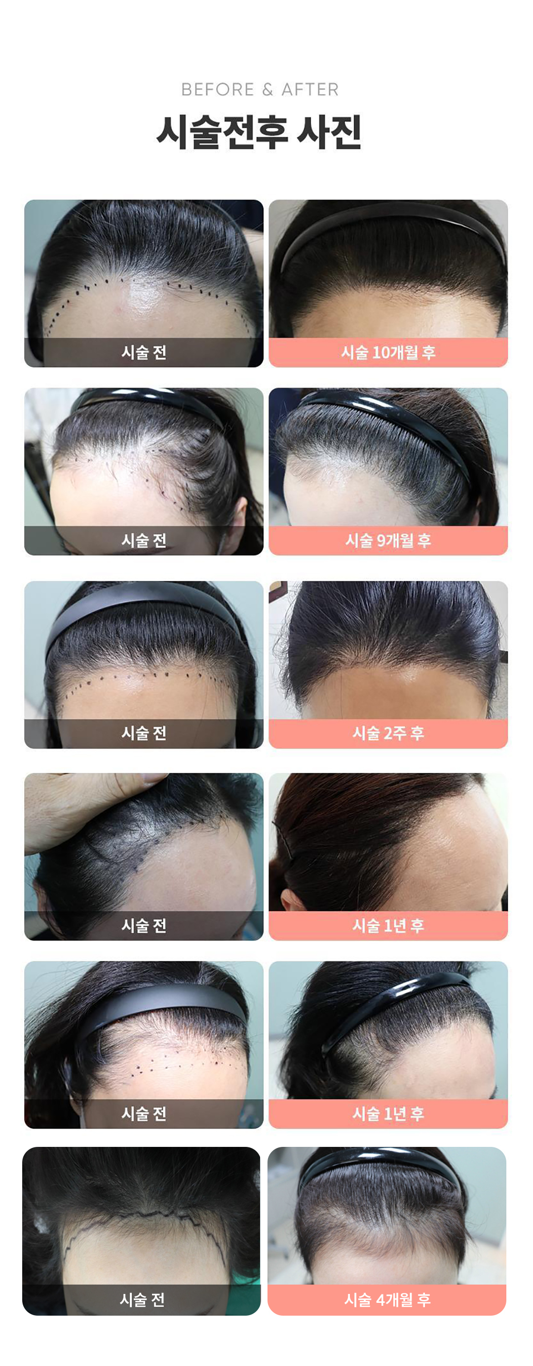 시간에 쫓기는 공장식 수술은 NO!!
모발 이식 경력 15년 전담의 2명이 협력하여 고도의 집중력으로 정확한 진단과 분석을 통해 개인별 두상과 얼굴형을 고려해 진행하는 1 대 1 맞춤 고급 모발 이식