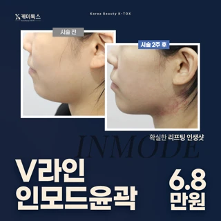 V라인 인모드리프팅&윤곽주사
