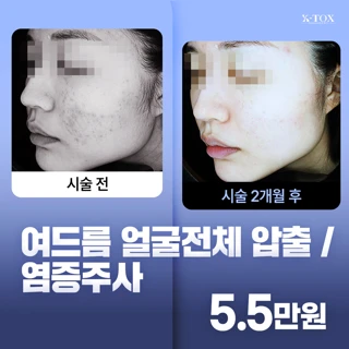  여드름 얼굴전체 압출,염증주사G