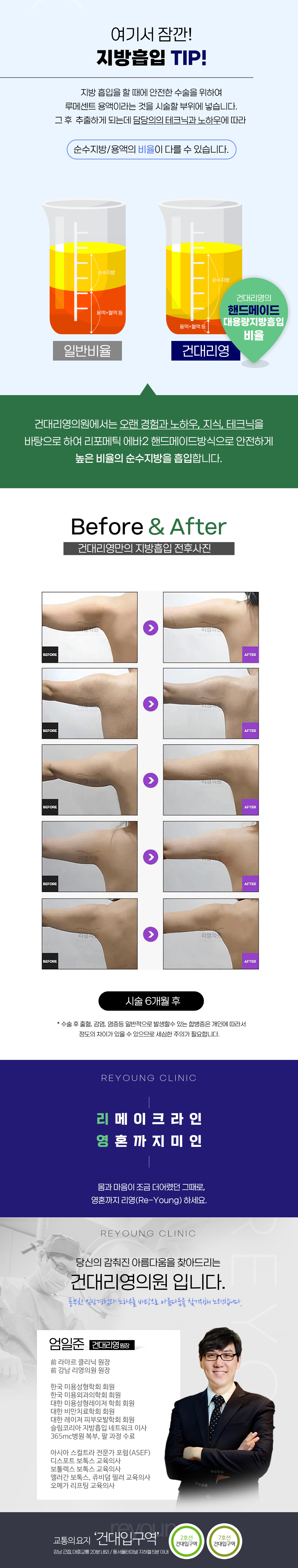 섬세한 핸드, 강력한 파워 리얼대용량 전체지방흡입  팔지흡 여리여리 ㄱ핏