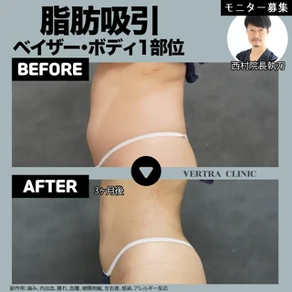 【西村院長執刀】ベイザー脂肪吸引ボディ1部位