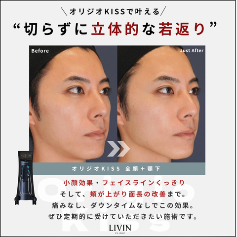 【利用条件】
モニター限定
〈別途かかる費用〉
初診再診料・カウンセリング料:込み(料金に含まれております)
【オリジオKISSについて】
オリジオKISSは、進化型リフトアップ機器として開発されたオリジオシリーズの最上位モデル。
1台でHIFU(高密度焦点式超音波)とRF(高周波)の両方を照射でき、真皮層〜SMAS筋膜層まで立体的にアプローチします。
LIVIN CLINICのオリジオKISSでは、SMAS層への熱照射によって肌の土台から引き締めを行い、自然なリフトアップとたるみの根本改善を目指します。
切らないたるみ治療の中でも、即時性と持続力に優れたハイブリッド型治療です。
【モニター条件】
・施術前と施術後の写真をSNSでの掲載可能な方
・当院の口コミにご協力いただける方
【施術をお受けいただけない方】
・人工心臓ペースメーカー、人工内耳などの埋め込み型デバイスを使用している方
・妊娠している方、または妊娠の可能性がある方
・授乳中の方
・持病があり医師に治療を禁止されている方
・本治療(成分)にアレルギーをお持ちの方、重症アレルギーを発症したことのある方
・4週間以内にボトックスまたはフィラーを注入した方
・1〜3ヶ月以内に糸リフトや手術を受けた方
・6ヶ月以内に施術部位に脂肪移植や皮膚移植をした方
・固定ピンなどの人工インプラント、金属の糸が留置されている方
・1ヶ月以内にアートメイクを入れている部位
・治療間隔が不十分な方
・肌状態が悪化している方、治療部位に炎症がある方
・1週間以内にピーリングやピーリング剤を含む薬剤やスキンケアを使用している方
・イソトレチノインを内服中の方
・感染症、ヘルペス、皮膚疾患をお持ちの方
【キャンセルポリシー】
ご予約につきましては、スタッフの人員を確保し他の方の予約制限も行う為、できる限りキャンセルや日時の変更を避けるよう、ご協力をお願いしております。やむを得ない事情でキャンセルまたは日時の変更をする場合は、早めにご連絡ください。
予約の変更、キャンセルをご希望される場合は、予約日前々日の19時までに(予約日前日が休診の場合は3日前)お電話またはLINEにてご連絡をお願いします。
患者様都合にて、ご予約の前日当日にキャンセルまたは日時の変更をする場合は、キャンセル変更料として2,200円発生いたします。
ここに言う患者様の都合には、患者様の故意、過失によらないものも含まれます(例:交通事故、交通遅延等の第三者の責任によるもの、ご自身のご体調不良や近親者の冠婚葬祭等)
体調不良の場合、インフルエンザへの罹患、Covid-19感染等の急病が理由の場合もキャンセル扱いとなります。
交通事故、交通網のトラブルによる遅刻により施術が困難な場合、親族の不幸があった場合などもキャンセル扱いとなります。
※お手術のご予約のみ、キャンセルポリシーの内容が異なります。詳しくはお手術の契約時に説明をさせて頂きます。
【予約に関する注意事項】
ご予約当日は、カウンセリング前に問診票のご記入がございますので、恐れ入りますがご予約時間の10分前を目安にご来院くださいますようお願いいたします。
カウンセリングは、通常1〜2時間ほどお時間を頂戴しております。 ご案内の順番や内容により前後する可能性がございますため、あらかじめご帰宅のお時間に余裕をもってご来院くださいませ。