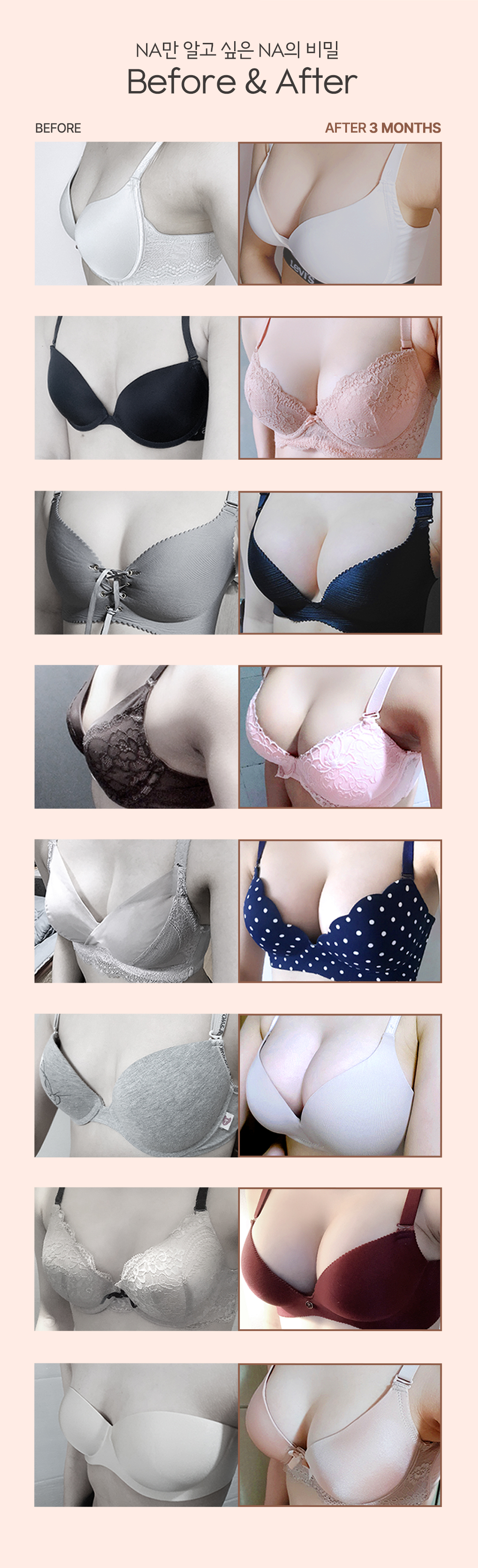 자연스럽고 풍만한 나나 커스터마이징 자만한 가슴성형
당일수술&퇴원 모양,촉감,안정성까지 OK