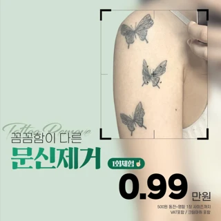 나세르 문신제거 1회체험