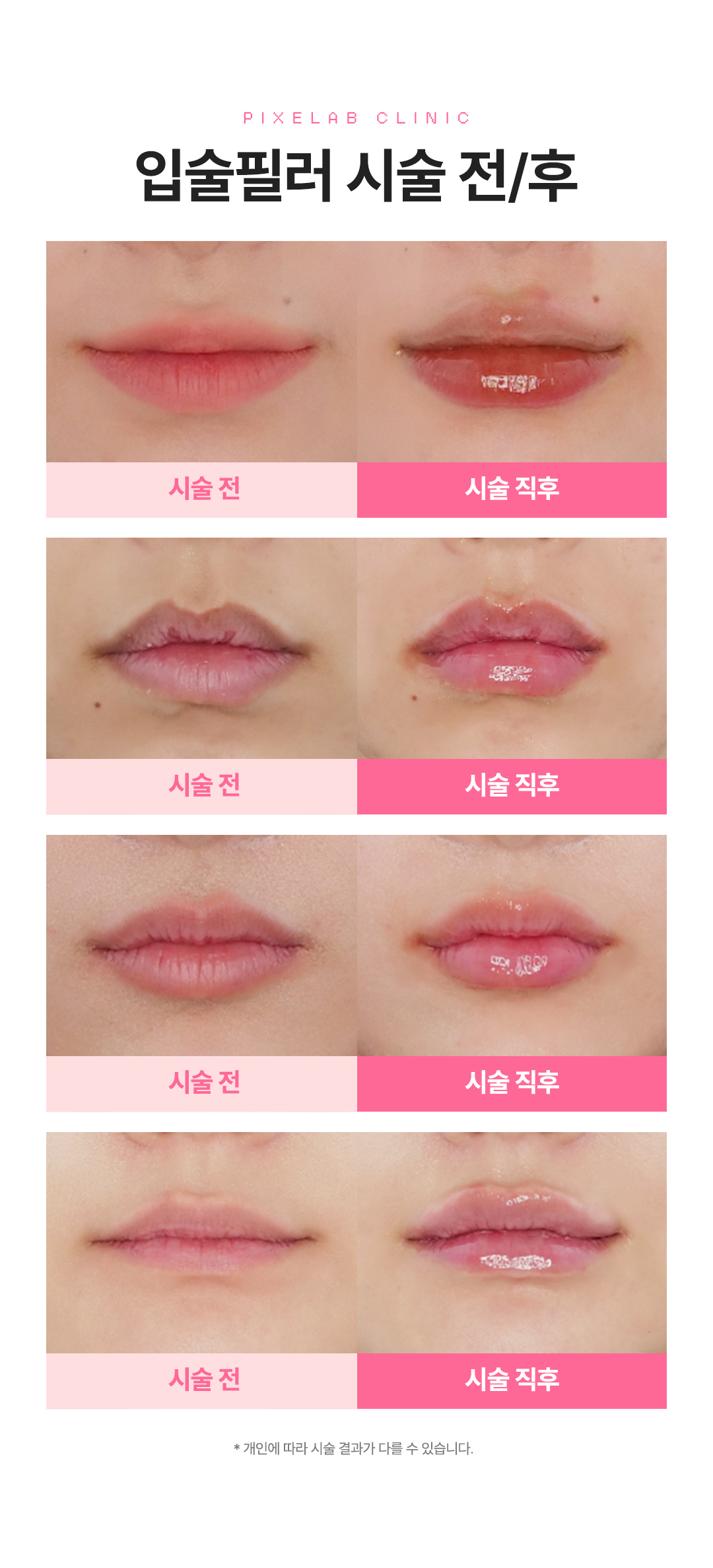 개인별 맞춤 시술로 도톰하고 탱탱한 푸팅 입술 만들기
나에게 맞는 입술 비율과 모양을 찾아 디자인하는 비스포크 입술필러
-1부위(윗입술,아랫입술,입꼬리 중 1부위) 최대 1cc입니다.
다른 부위로 남은 용량 시술이 어렵습니다.
