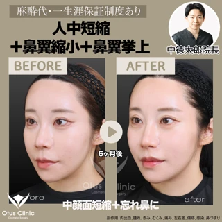 【局所麻酔代込】人中短縮＋鼻翼縮小＋鼻翼挙上｜中顔面短縮＋忘れ鼻に
