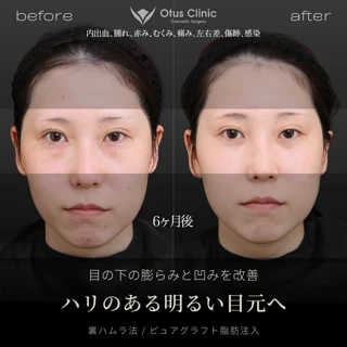 【局所麻酔代込み】裏ハムラ|目の下の凹凸を解消
