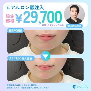 【雲山ドクター限定】アラガン社製ヒアルロン酸注入 1cc|ジュビダームビスタ®︎シリーズ