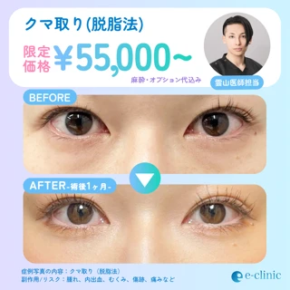 【麻酔・オプション代込み】eクリ式クマ治療(目の下のたるみ取り)