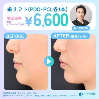 【雲山ドクター執刀】戻りにくい糸リフト|PDO・PCL