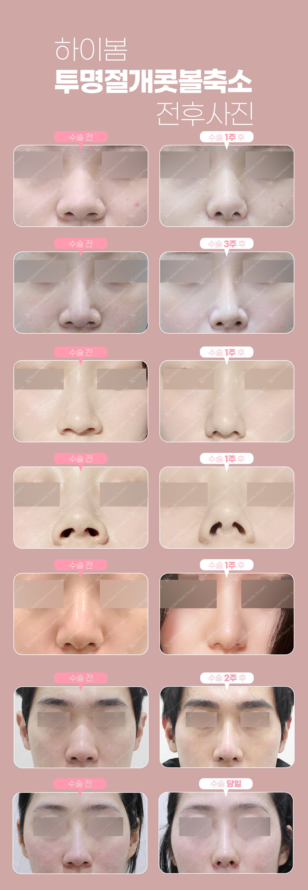 티안나게 흉터걱정_줄여주는 콧볼축소