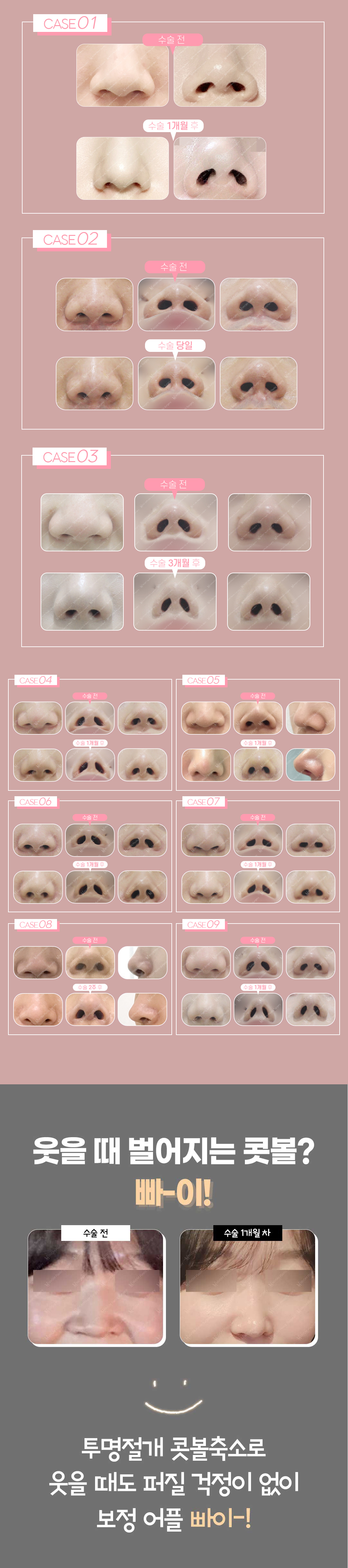 티안나게 흉터걱정_줄여주는 콧볼축소