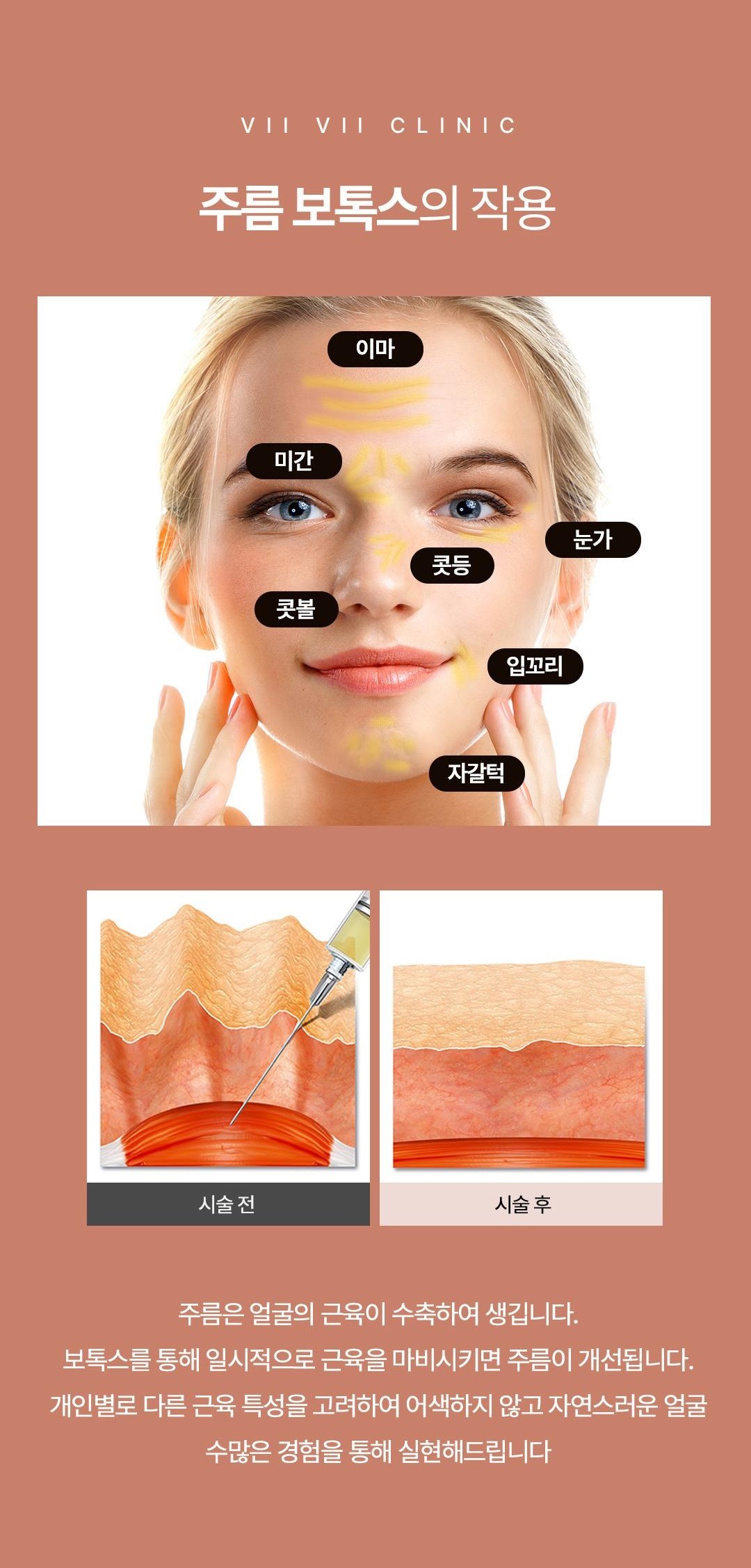 보톡스로 다양한 미용적 효과를 볼 수 있습니다..
꾸준히 맞으면 그렇지 않으신 분에 비해서 상당히 다른 인생을 살게 됩니다..
시술자의 손감각에 따라 효과가 매우 달라지게 됩니다..