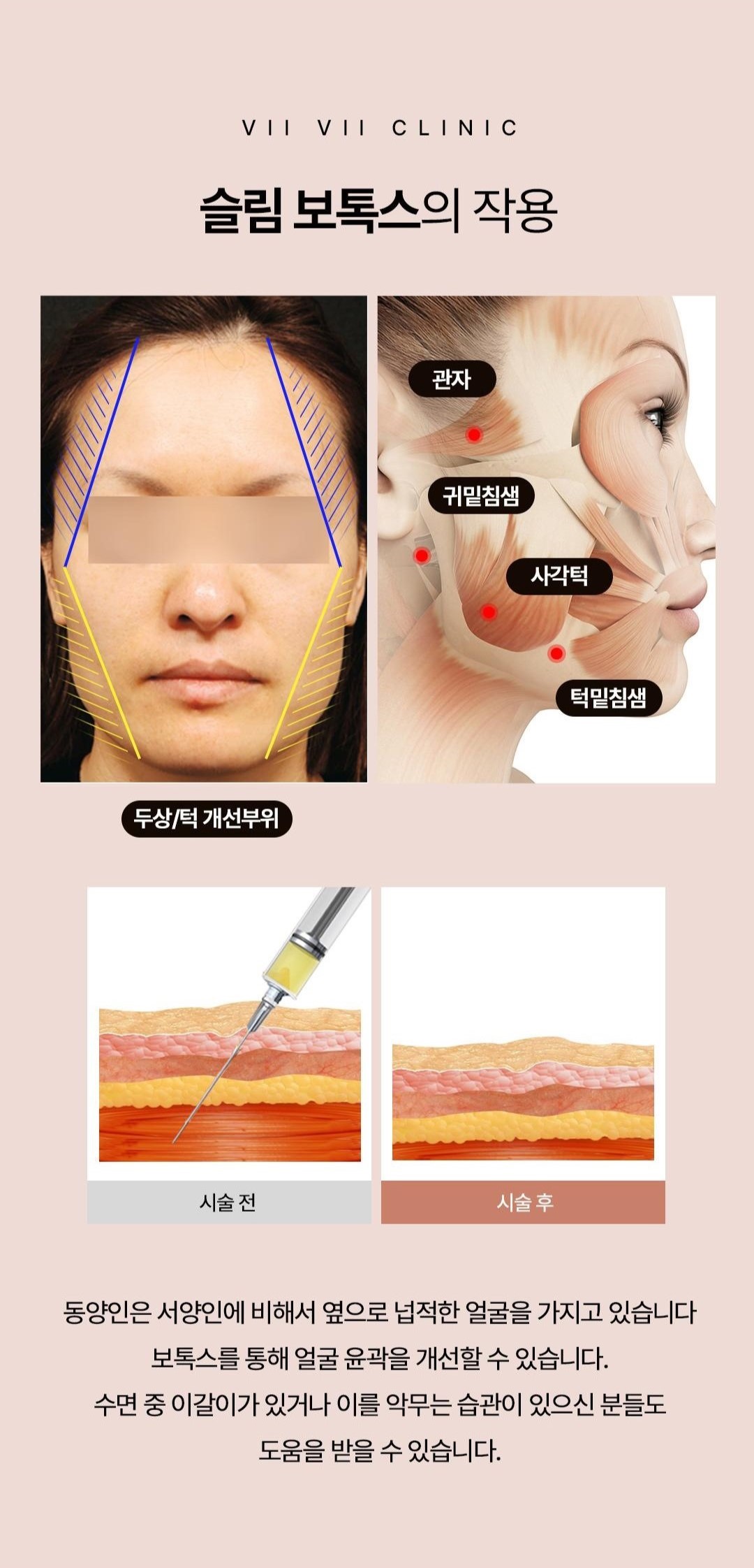 보톡스로 다양한 미용적 효과를 볼 수 있습니다..
꾸준히 맞으면 그렇지 않으신 분에 비해서 상당히 다른 인생을 살게 됩니다..
시술자의 손감각에 따라 효과가 매우 달라지게 됩니다..