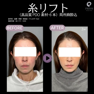 糸リフト(高品質PDO素材・6本)|局所麻酔代込み