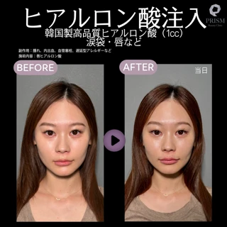 【特別価格】ヒアルロン酸注入|韓国製高品質ヒアルロン酸(1cc)|涙袋・唇など