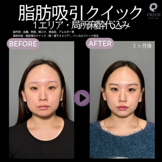 【1周年記念特別価格】脂肪吸引クイック|1エリア・局所麻酔代込み