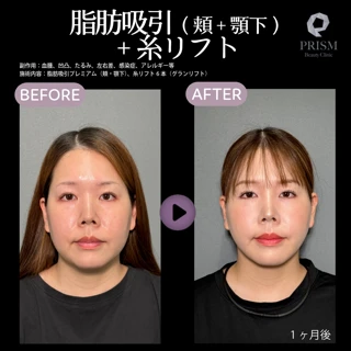 【小顔整形専門クリニック】脂肪吸引(頬+顎下)+糸リフト