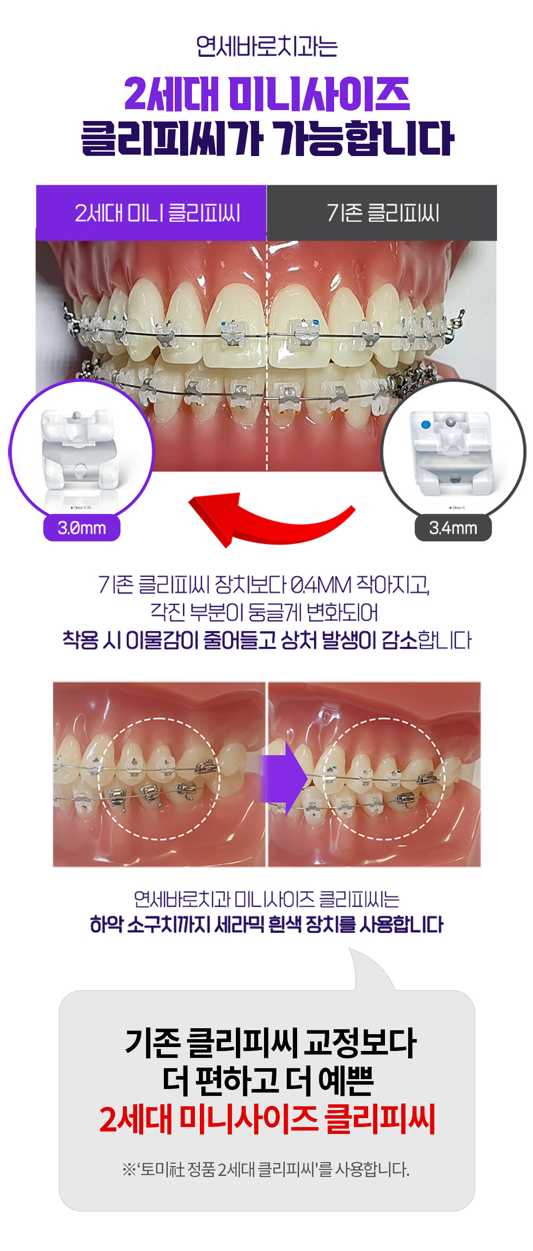 통증, 치과방문 횟수, 교정기간, 심미성 걱정을 줄인 편안한 치아교정 클리피씨